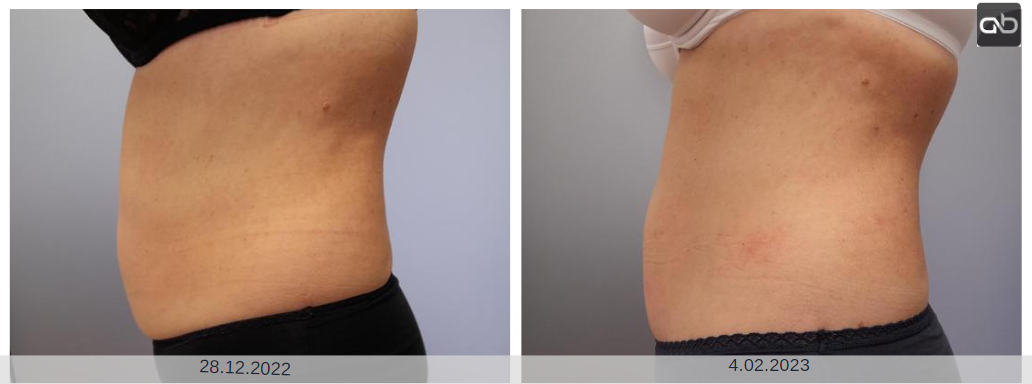 tratament tonifiere musculara DualFit