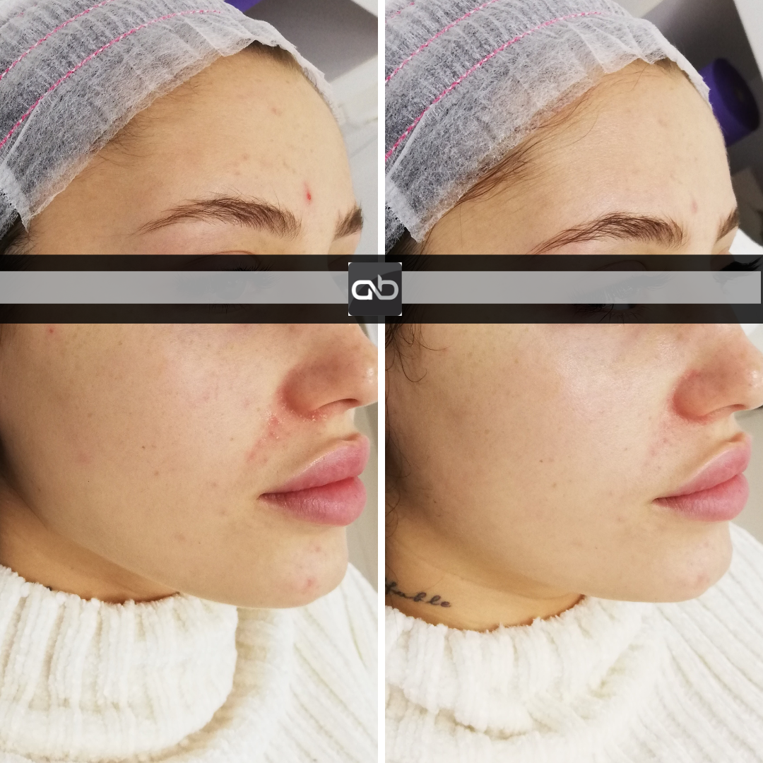 tratament facial mezoterapie SkinTera ElasticLab